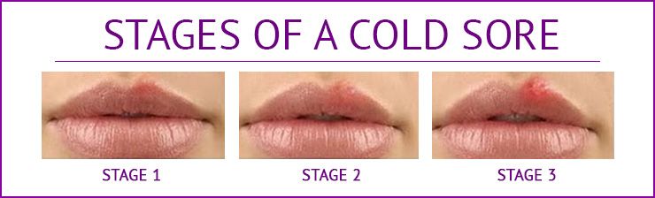 Cold Sore Stages Days Everything You Should Knowvalue Food